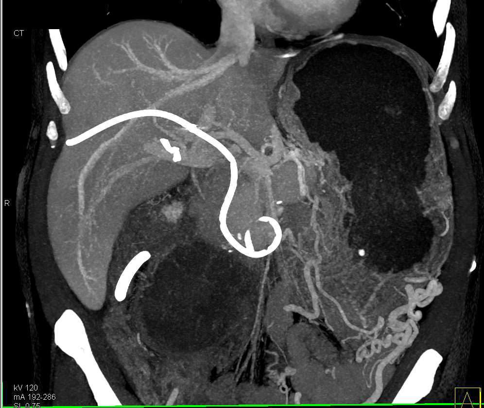 Infiltrating Pancreatic Cancer - CTisus CT Scan