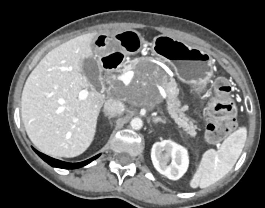 Infiltrating Pancreatic Adenocarcinoma with Arterial and Venous Encasement - CTisus CT Scan