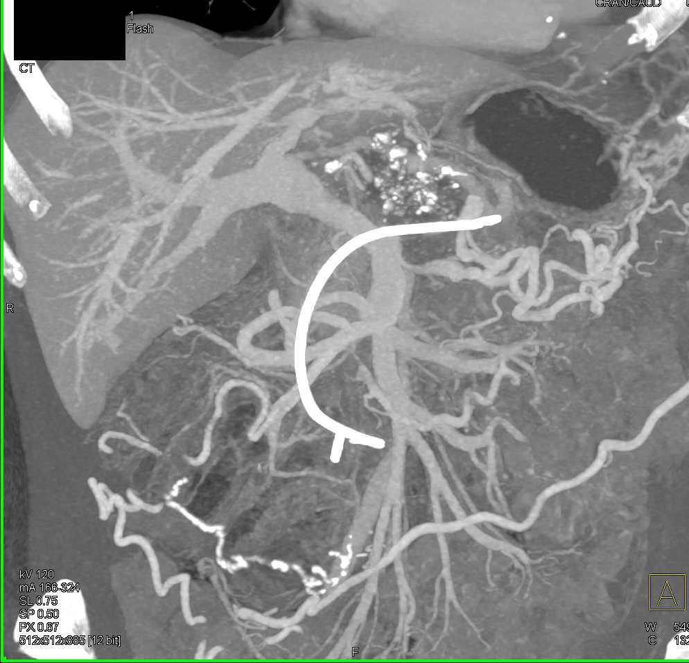 Infiltrating Pancreatic Adenocarcinoma with Arterial and Venous Encasement - CTisus CT Scan