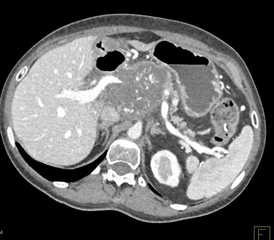 Inferior Vena Cava (IVC) Clot and Pulmonary Embolism (PE) in Patient with Infiltrating Pancreatic Adenocarcinoma - CTisus CT Scan