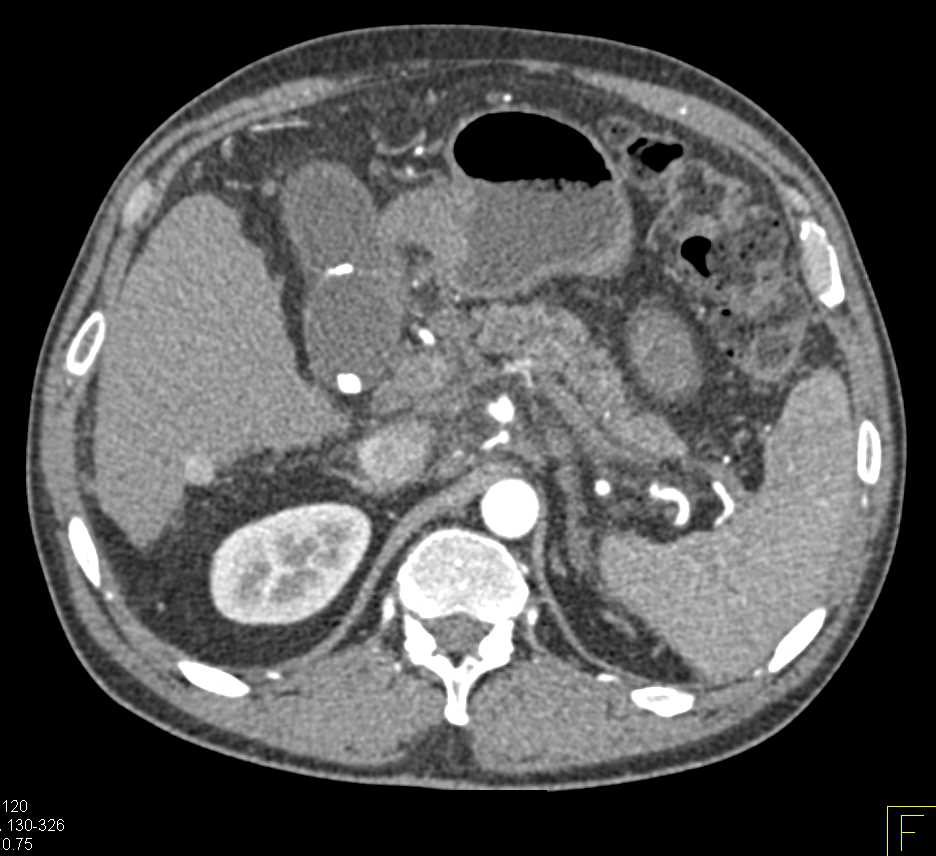 Pancreatic Cancer with Local Spread - CTisus CT Scan