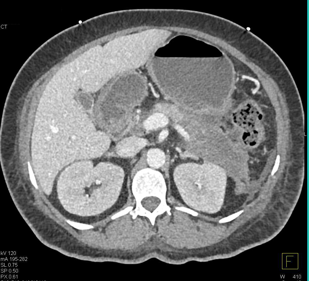 Acute Pancreatitis Involving the Distal Body and Tail of the Pancreas - CTisus CT Scan