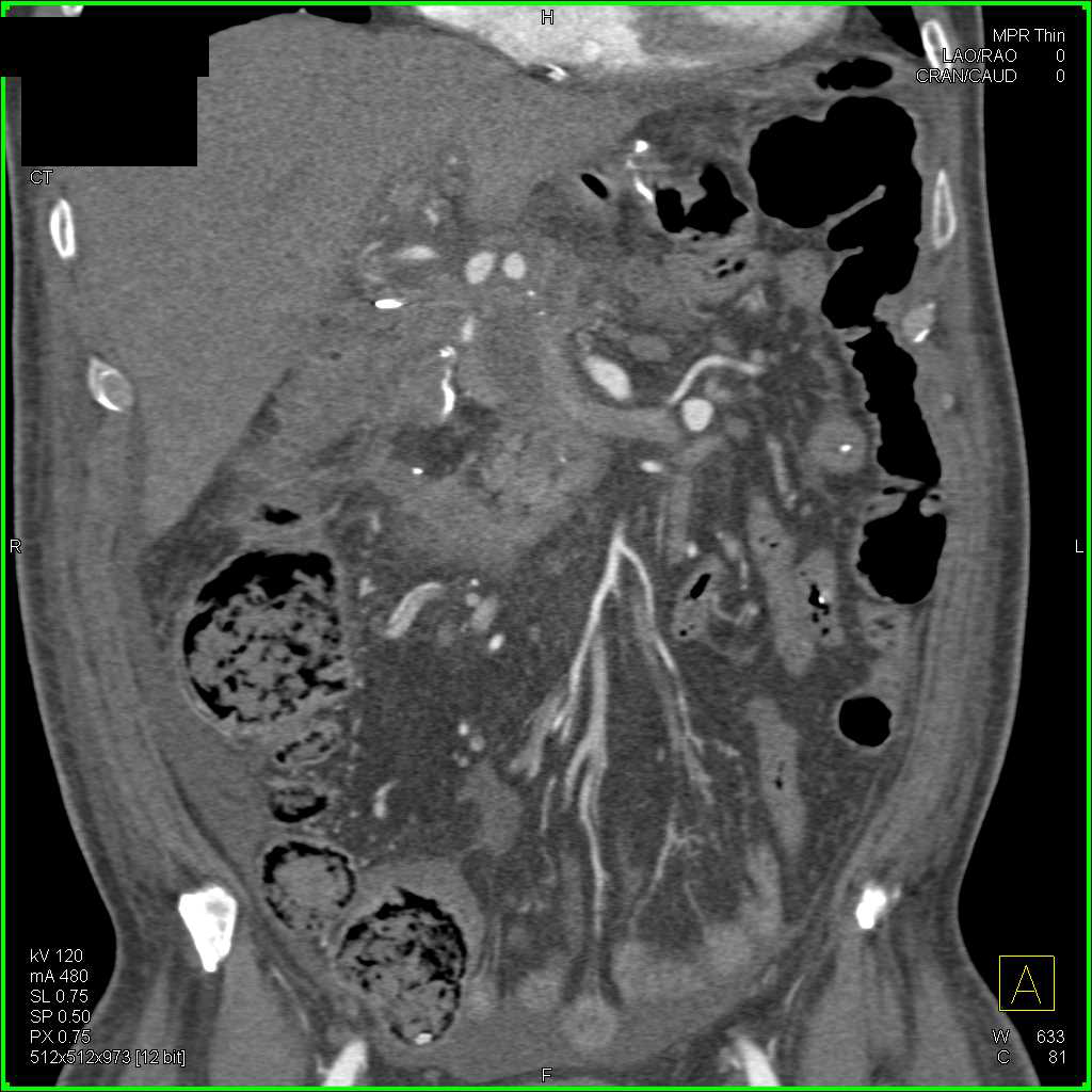 Recurrent Pancreatic Cancer - CTisus CT Scan