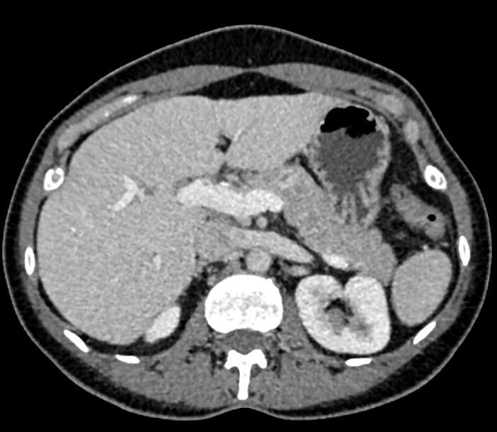 Autoimmune Pancreatitis Involves the Tail of the Pancreas - CTisus CT Scan