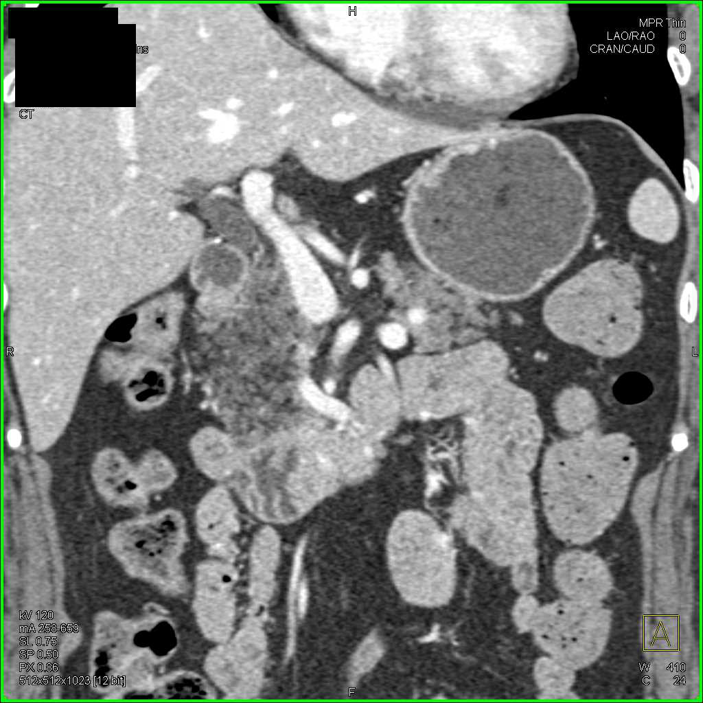 Fatty Infiltration Head of the Pancreas - CTisus CT Scan