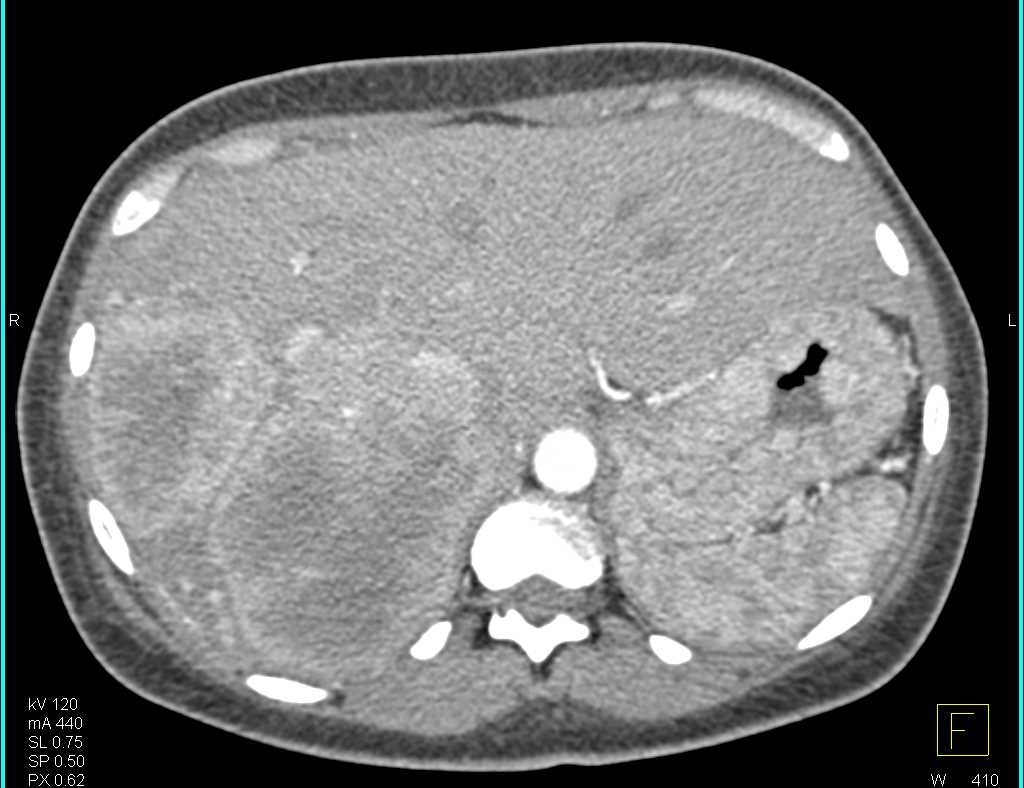 Metastatic Pancreatic Neuroendocrine Tumor - CTisus CT Scan