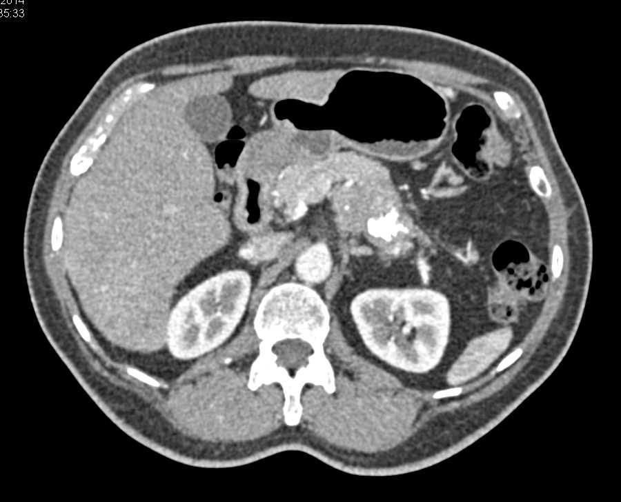 Neuroendocrine Tumor in the Tail of the Pancreas - CTisus CT Scan