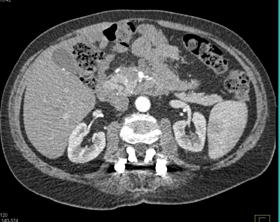 Infiltrating Carcinoma of the Body of the Pancreas - CTisus CT Scan