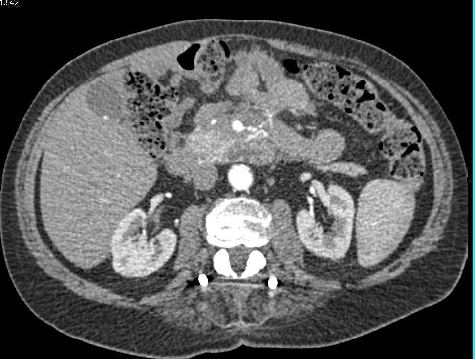 Infiltrating Carcinoma of the Body of the Pancreas - CTisus CT Scan