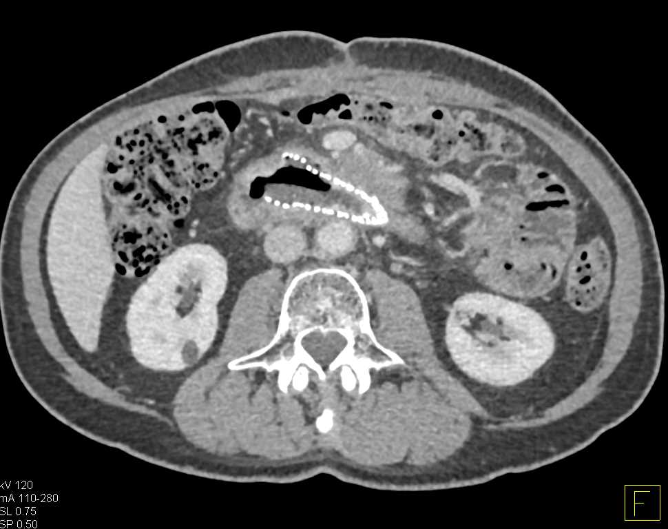 Pancreatic Cancer Invades the Duodenum with Endoluminal Stents - CTisus CT Scan