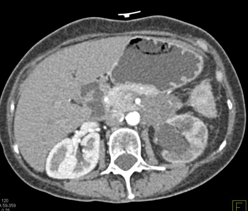 Carcinoma Tail of Pancreas Extends to Involve the Left Kidney - CTisus CT Scan