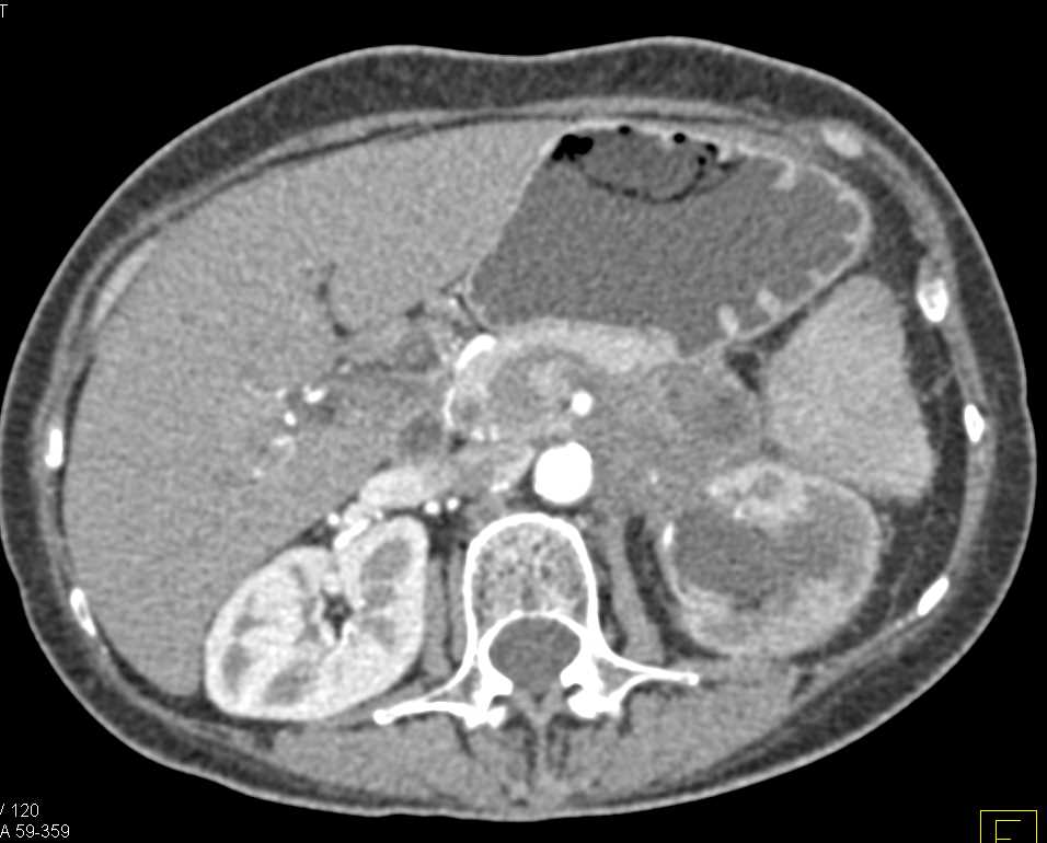 Carcinoma Tail of Pancreas Extends to Involve the Left Kidney - CTisus CT Scan