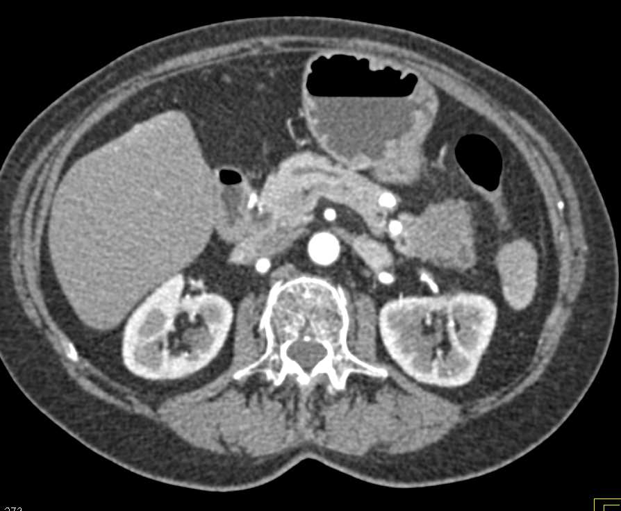 Adenocarcinoma of the Tail of the Pancreas - CTisus CT Scan