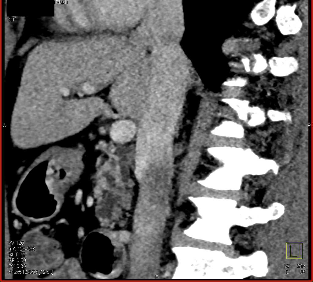 Intraductal Papillary Mucinous Neoplasm (IPMN) in Uncinate Process - CTisus CT Scan