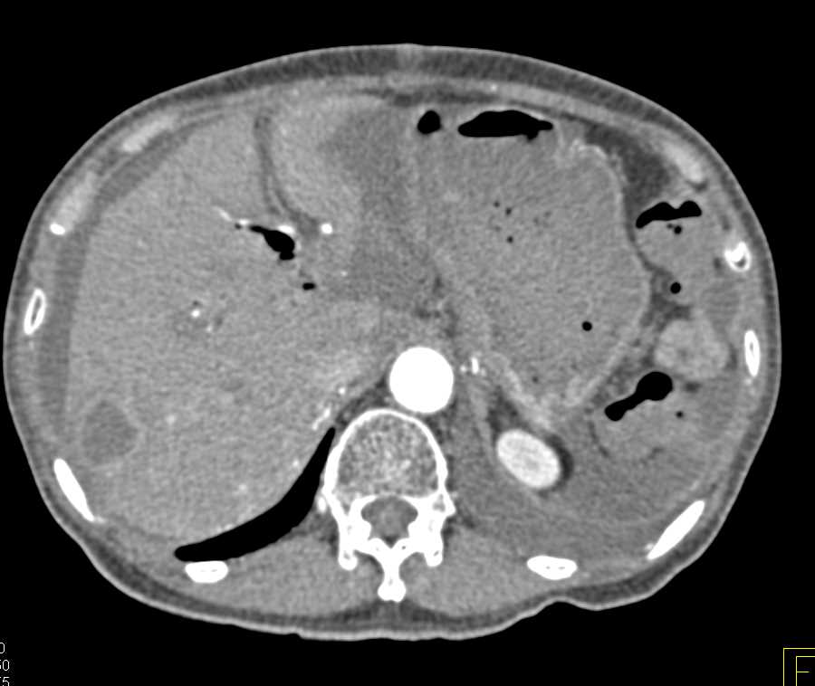 Pancreatic Cancer with Liver Metastases - CTisus CT Scan