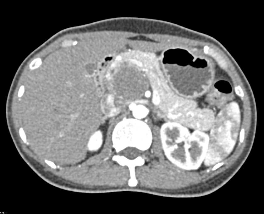 Neurogenic Tumor Near Head of the Pancreas - CTisus CT Scan