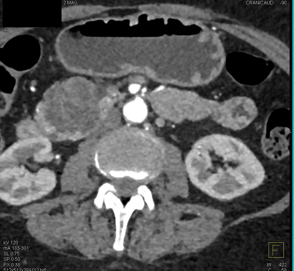 Serous Cystadenoma in the Head of the Pancreas - CTisus CT Scan