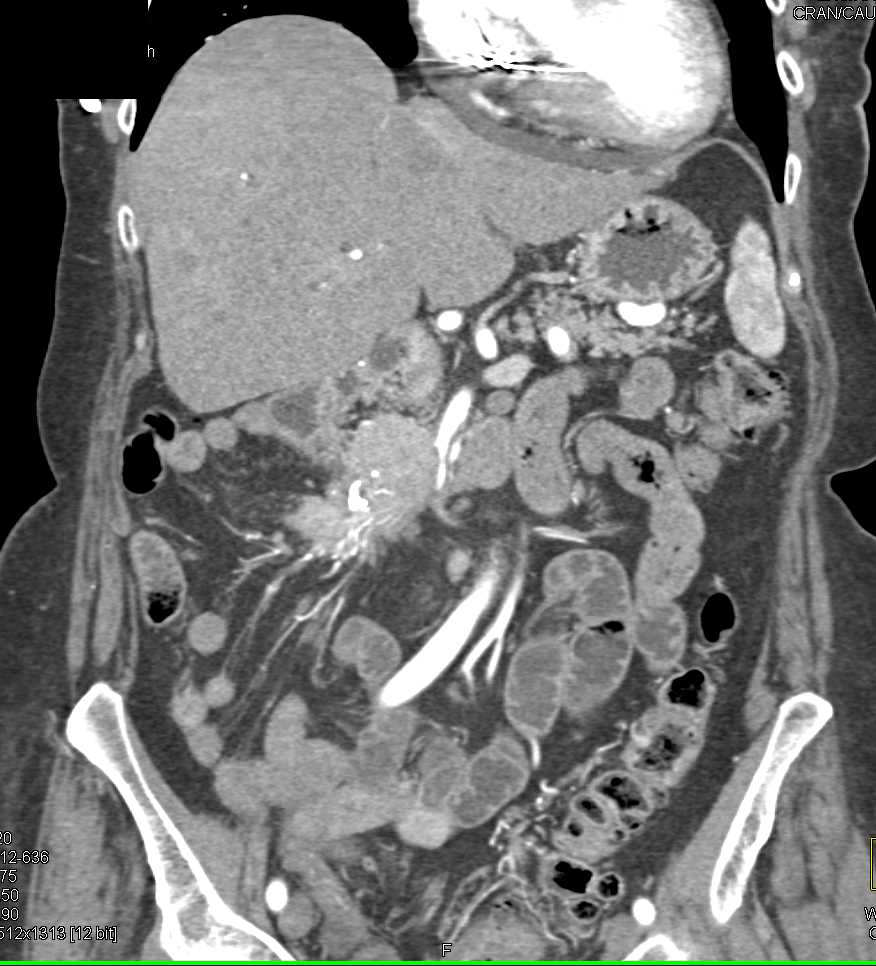 Pancreatic Cancer Encases Superior Mesenteric Artery (SMA) and Superior Mesenteric Vein (SMV) - CTisus CT Scan