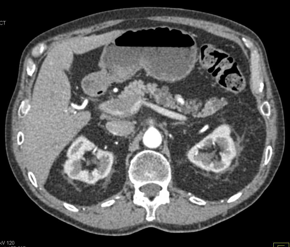 Multiple Intraductal Papillary Mucinous Neoplasms (IPMNs) in the Pancreas - CTisus CT Scan