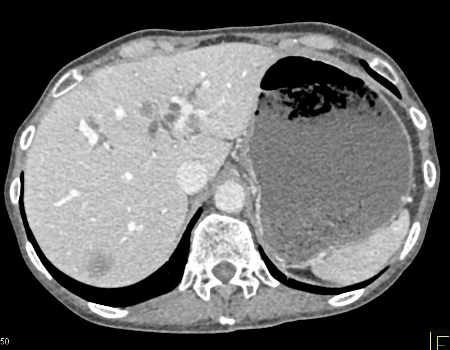 Pancreatic Cancer Encases the Portal Vein/SMV Confluence - CTisus CT Scan