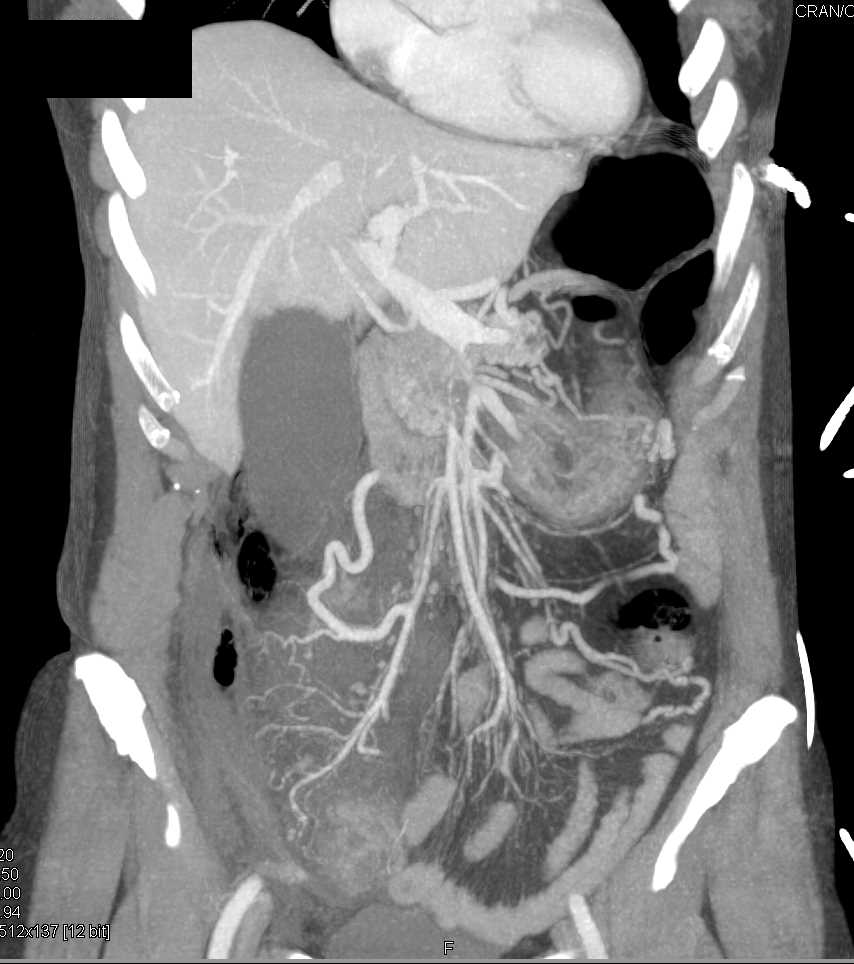 Post Endoscopic Retrograde Cholangiopancreatography (ERCP) Perforation with Retroperitoneal Abscess - CTisus CT Scan