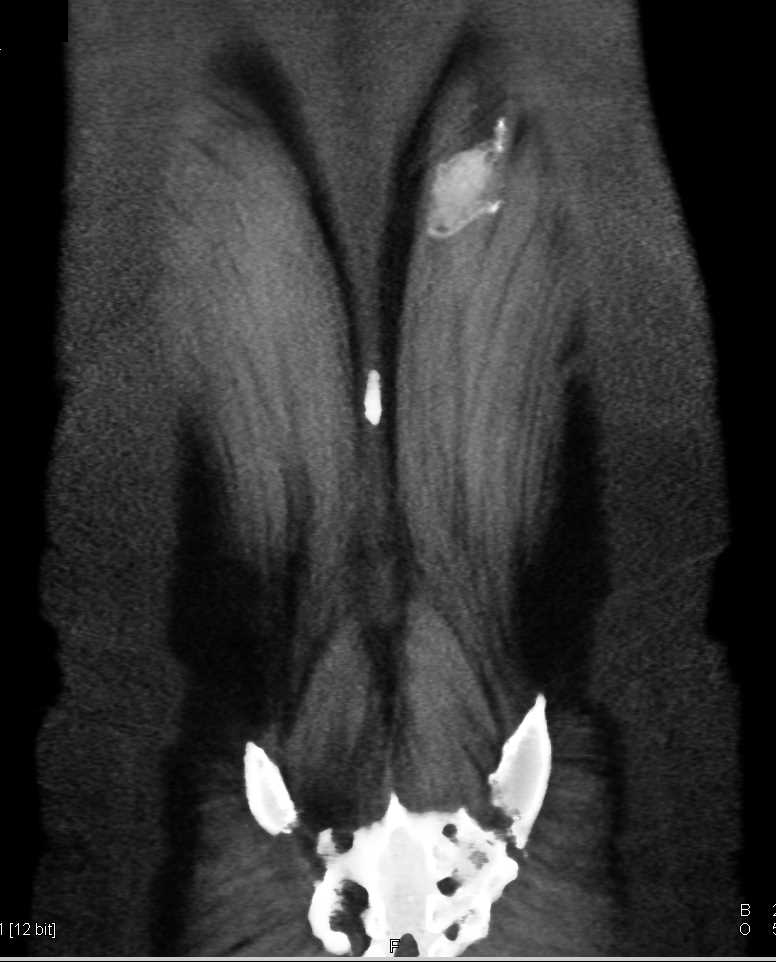 Pancreatic Neuroendocrine Tumor with Extrapancreatic Spread of Disease - CTisus CT Scan