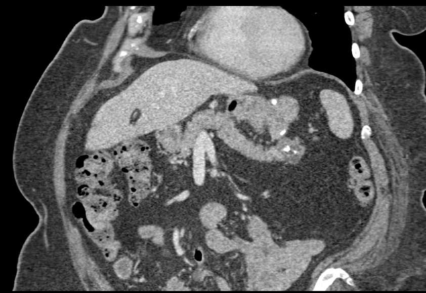 Pancreatic Neuroendocrine Tumor - CTisus CT Scan