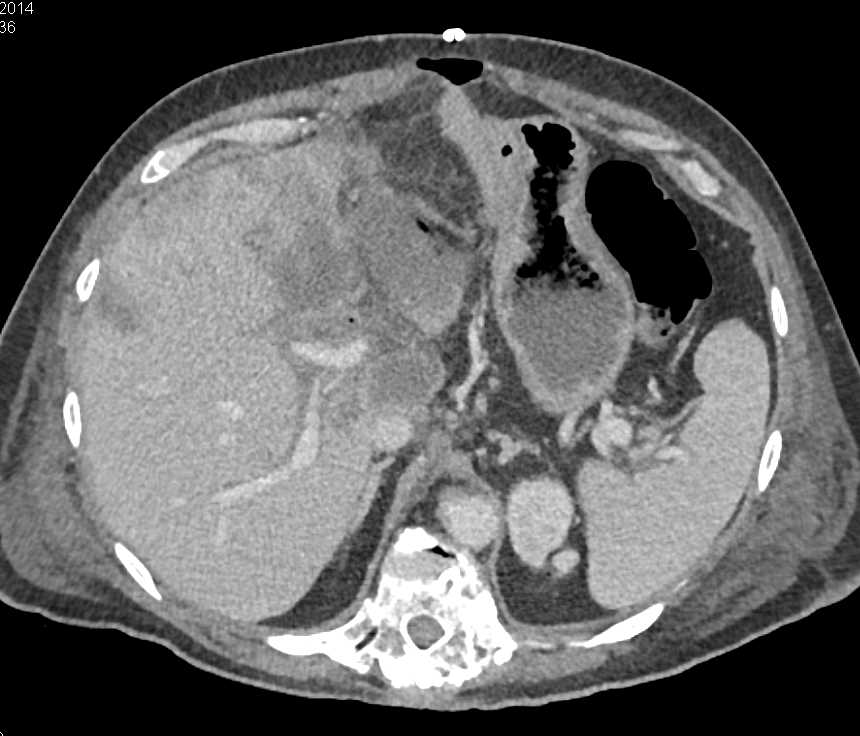 Liver Metastases in a Patient with Pancreatic Cancer - CTisus CT Scan