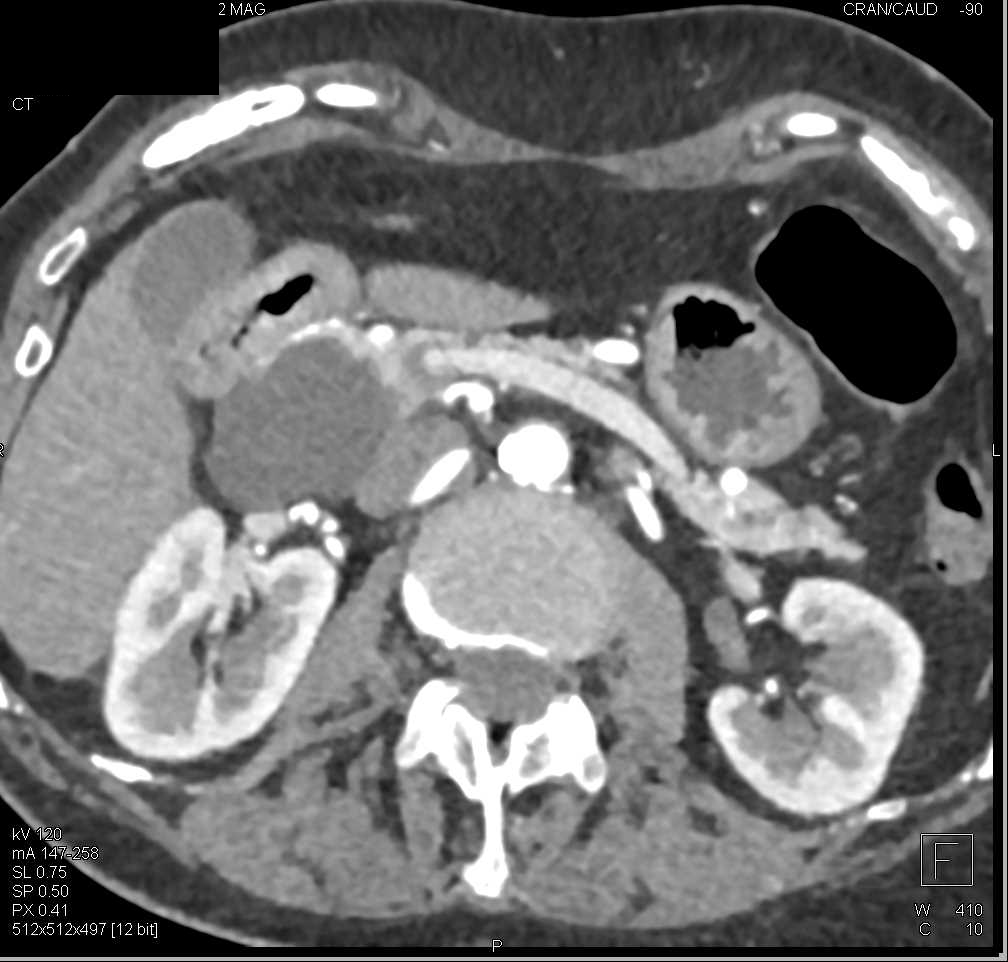 Serous Cystadenoma Head of Pancreas - CTisus CT Scan