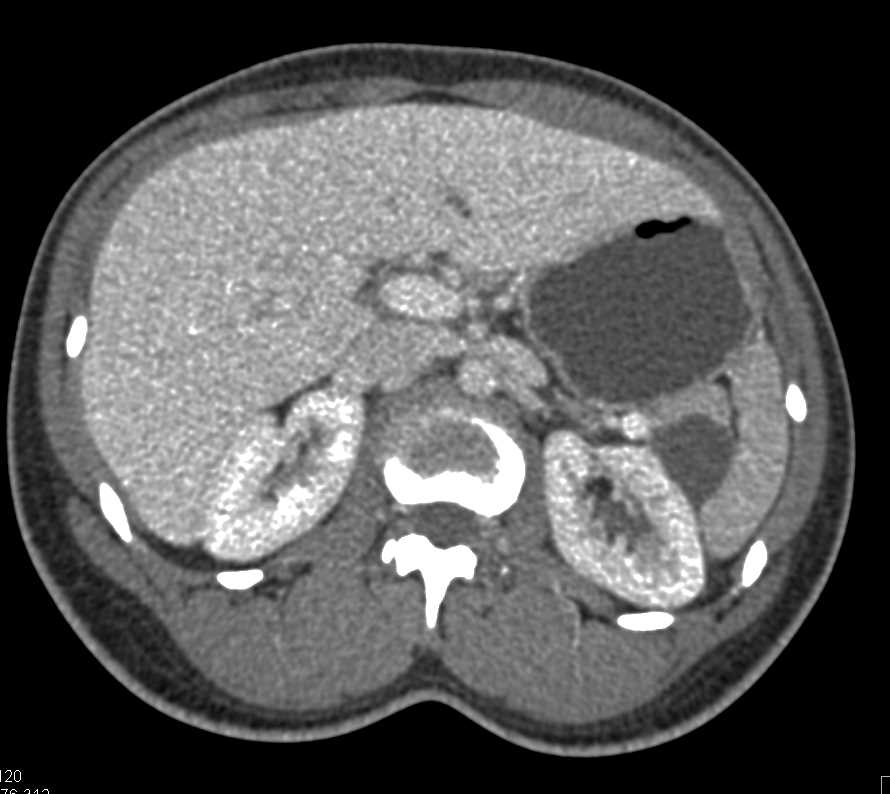 Intraductal Papillary Mucinous Neoplasm (IPMN) Tail of the Pancreas - CTisus CT Scan