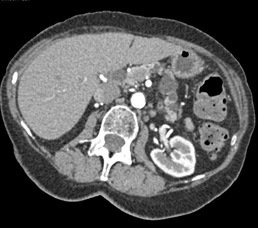 Post Whipple Pancreas with Multiple Intraductal Papillary Mucinous Neoplasms (IPMNs) - CTisus CT Scan