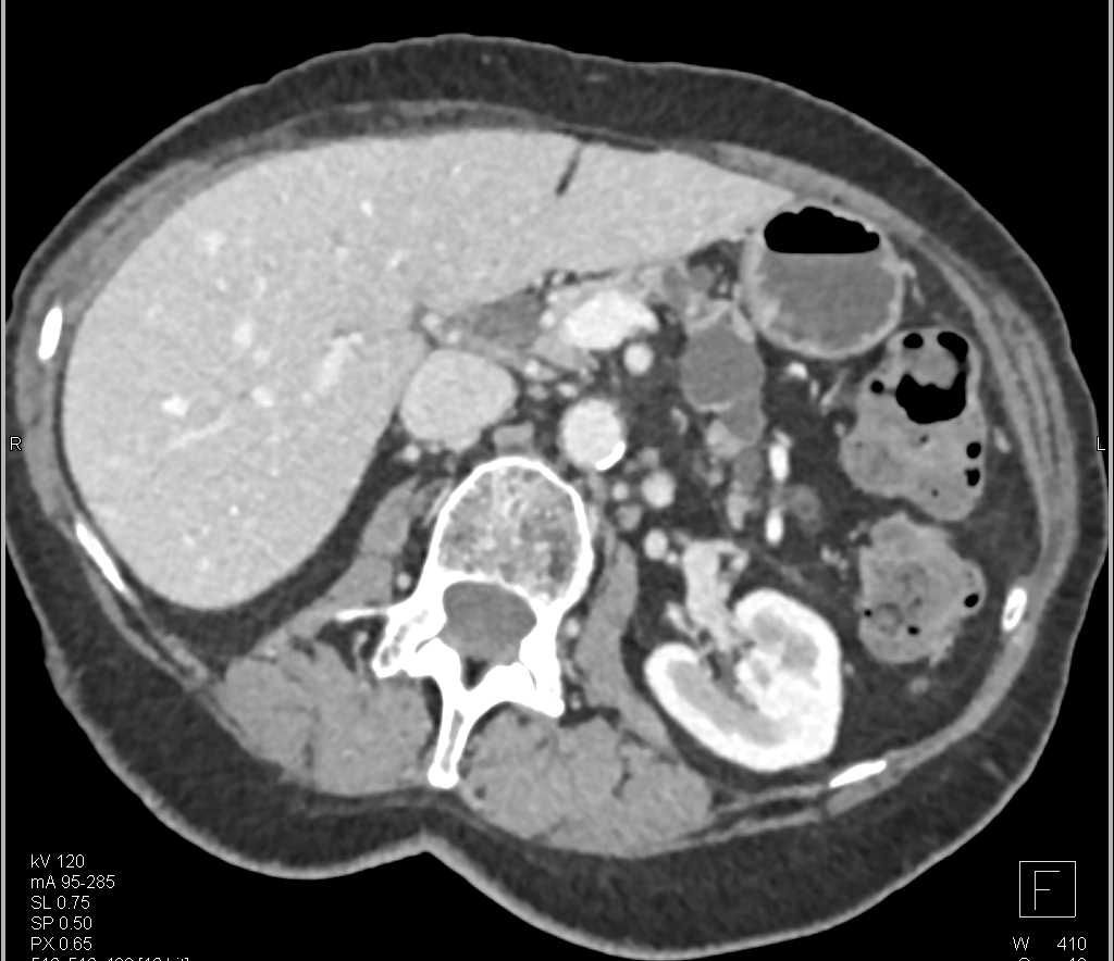 Post Whipple Pancreas with Multiple Intraductal Papillary Mucinous Neoplasms (IPMNs) - CTisus CT Scan