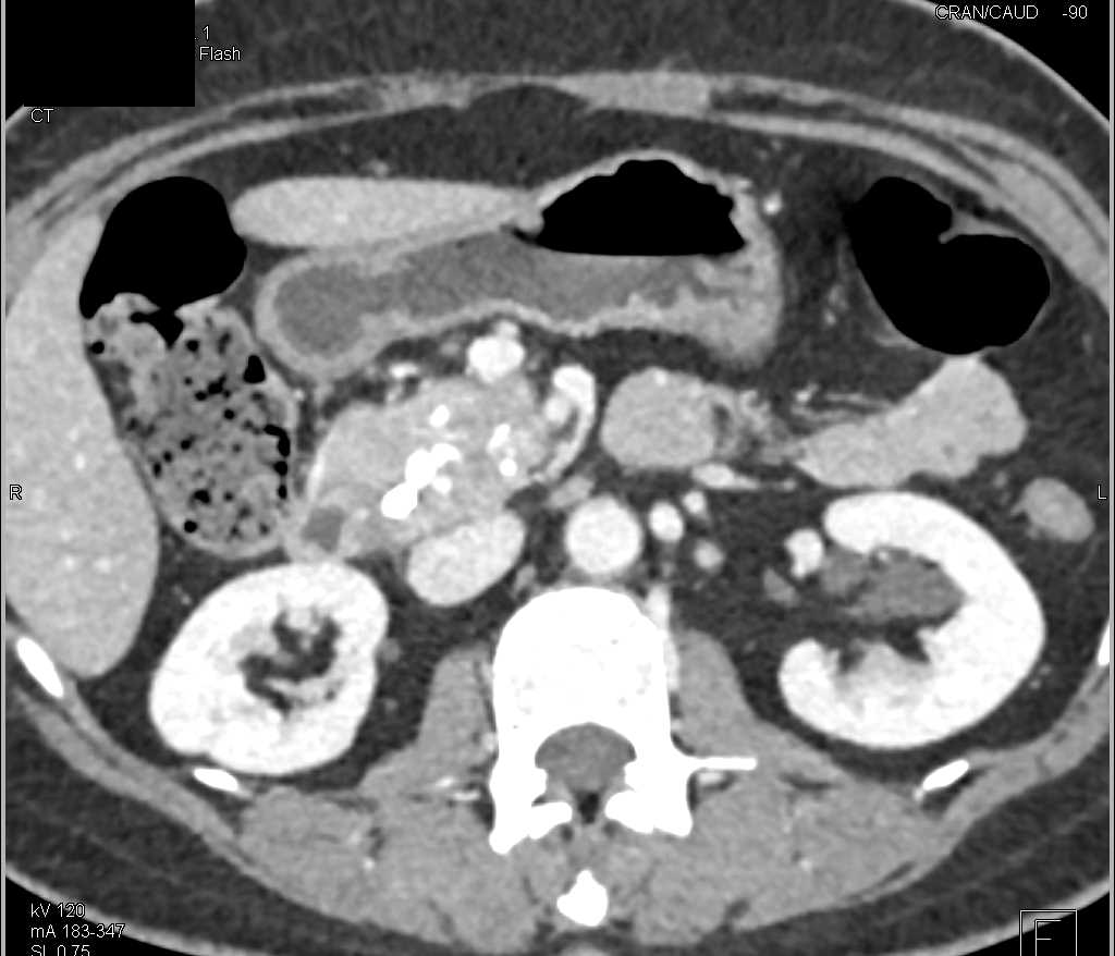 Pancreatic Cancer Arising in Chronic Pancreatitis - CTisus CT Scan