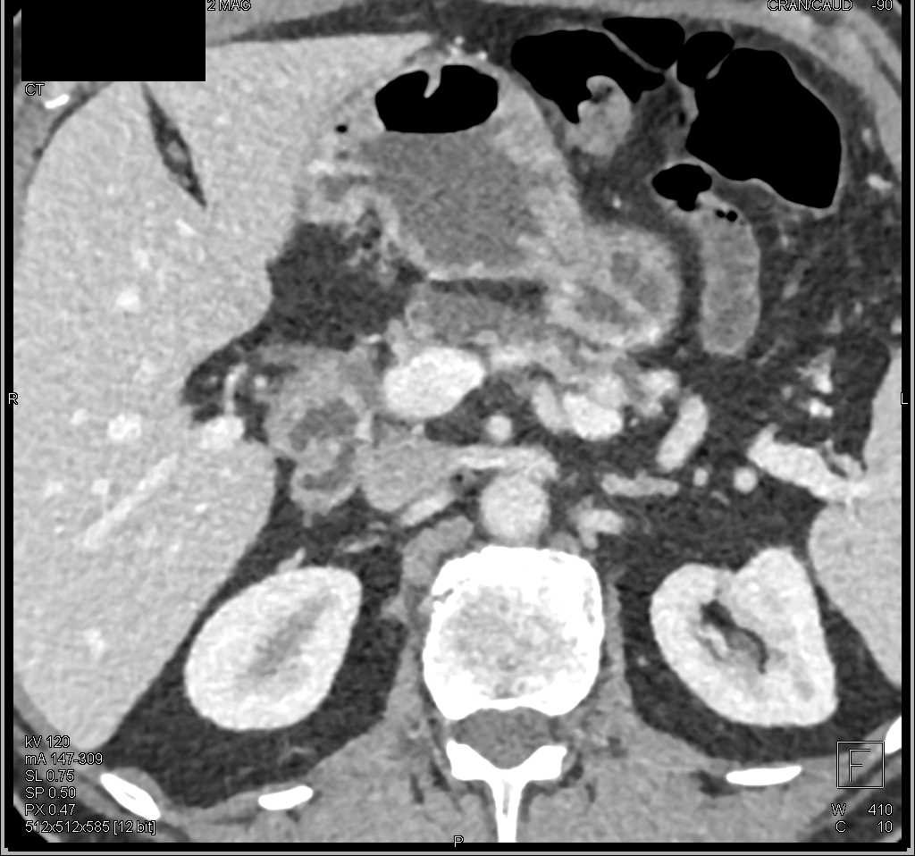 Main Duct Intraductal Papillary Mucinous Neoplasm (IPMN) - CTisus CT Scan