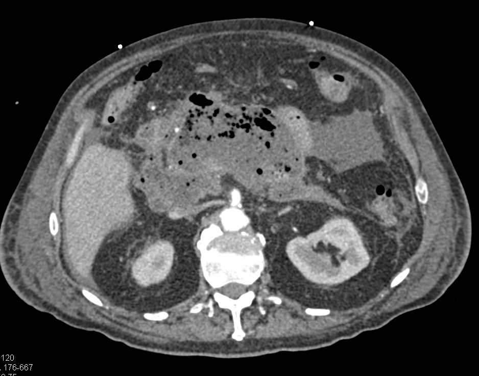 Infected Pancreatic Pseudocyst - CTisus CT Scan