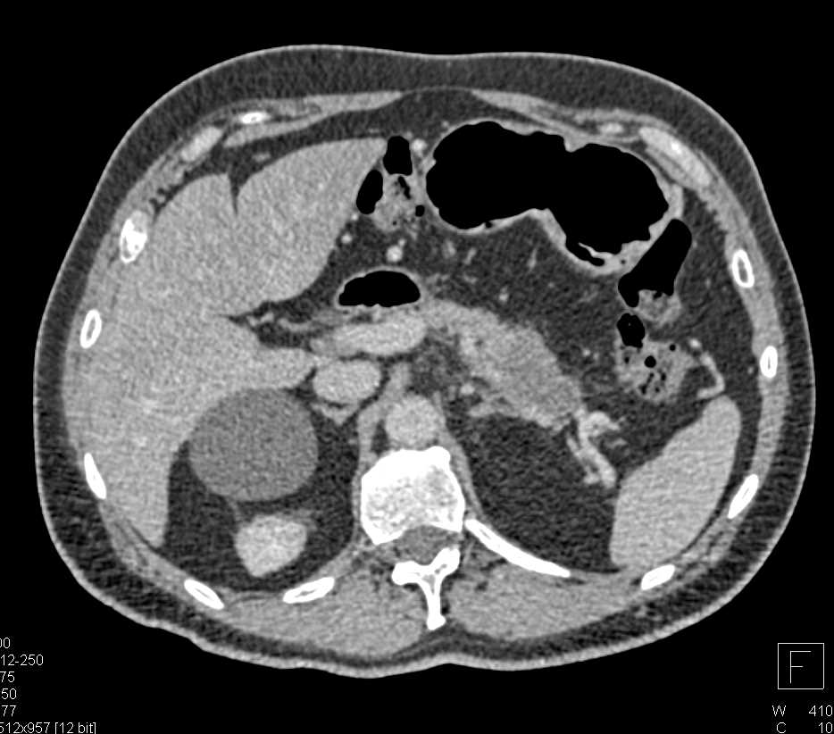 Carcinoma in the Tail of the Pancreas - CTisus CT Scan