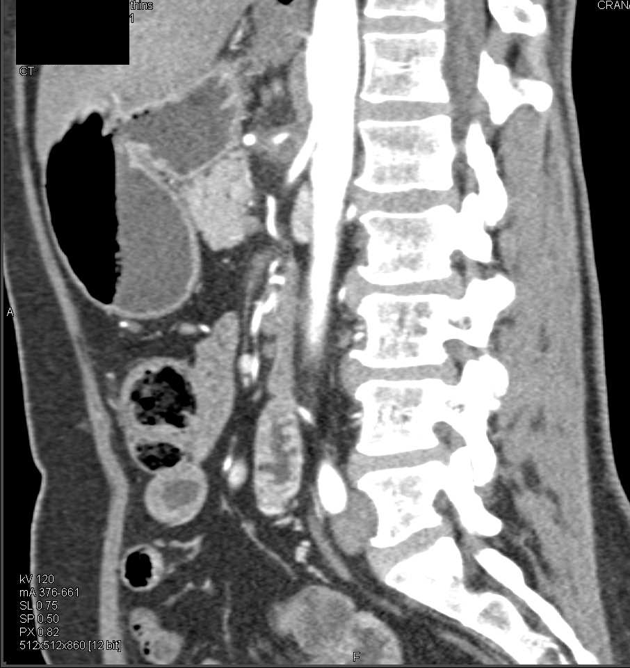 Pancreatic Cancer Encases the SMA - CTisus CT Scan