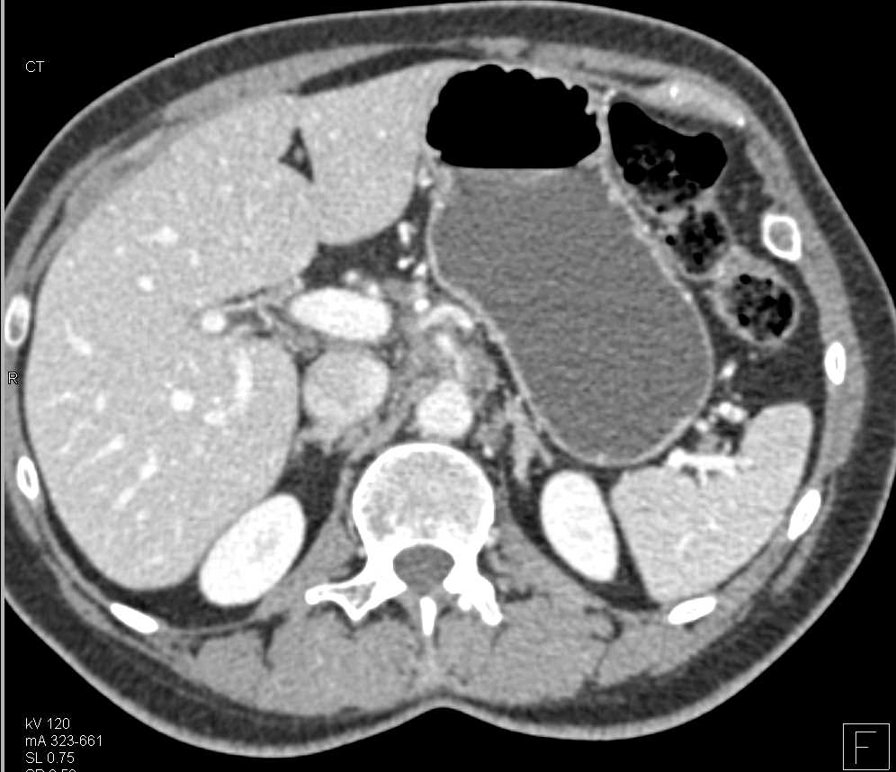 Pancreatic Cancer Encases the SMA - CTisus CT Scan