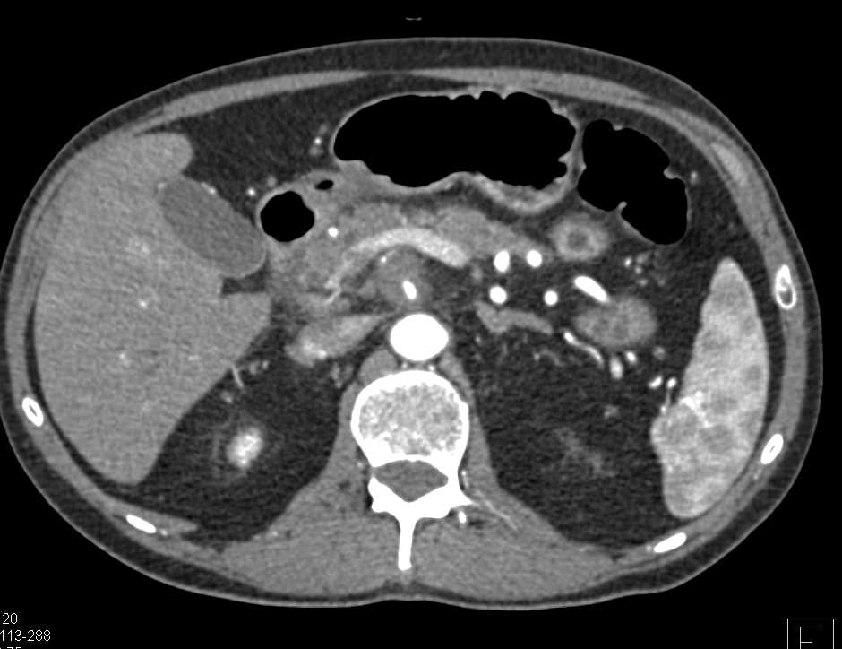 Pancreatic Cancer with Superior Mesenteric Artery (SMA) and PV/SMV Encasement - CTisus CT Scan