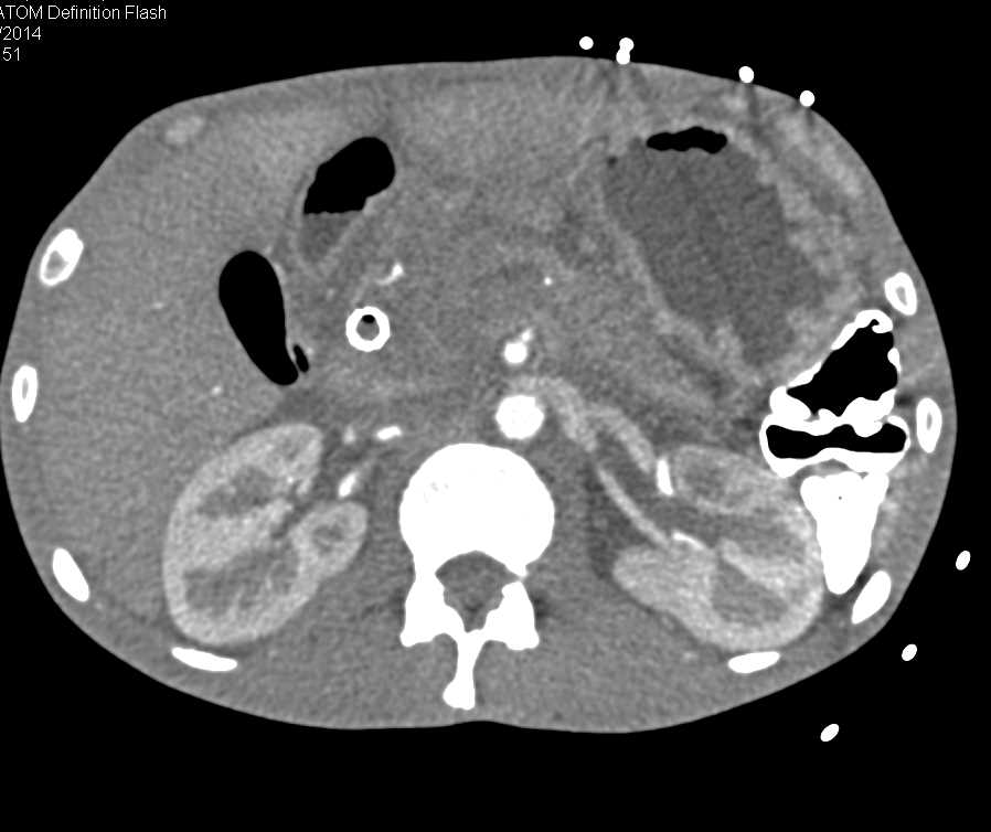 Pancreatic Cancer with Arterial and Venous Encasement - CTisus CT Scan