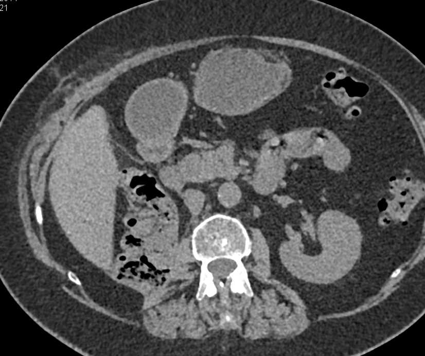 Metastatic Renal Cell Carcinoma to the Pancreas - CTisus CT Scan