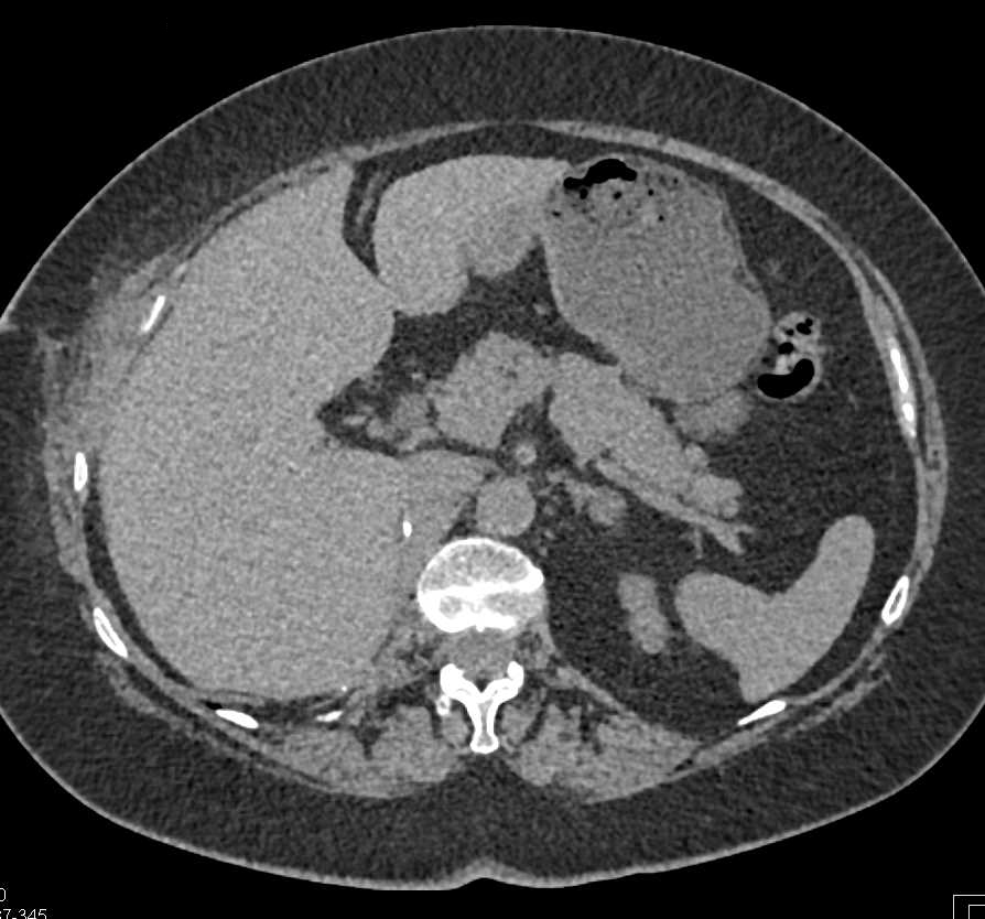 Metastatic Renal Cell Carcinoma to the Pancreas - CTisus CT Scan