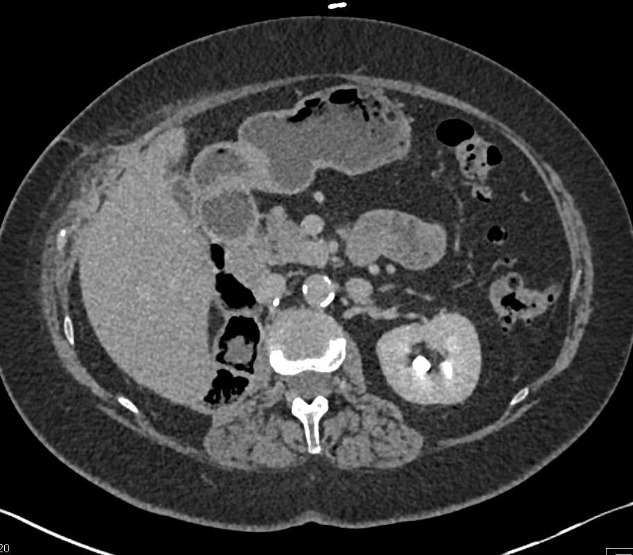 Metastatic Renal Cell Carcinoma to the Pancreas - CTisus CT Scan