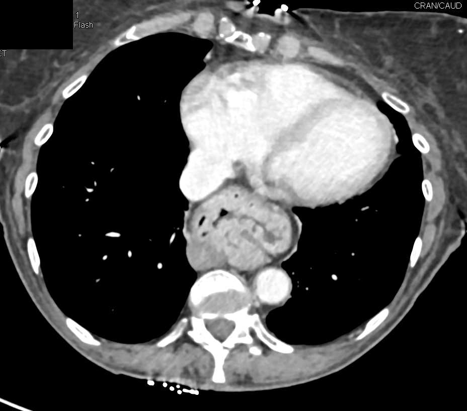 Large Hiatal Hernia and Subtle Pancreatic Cancer - CTisus CT Scan