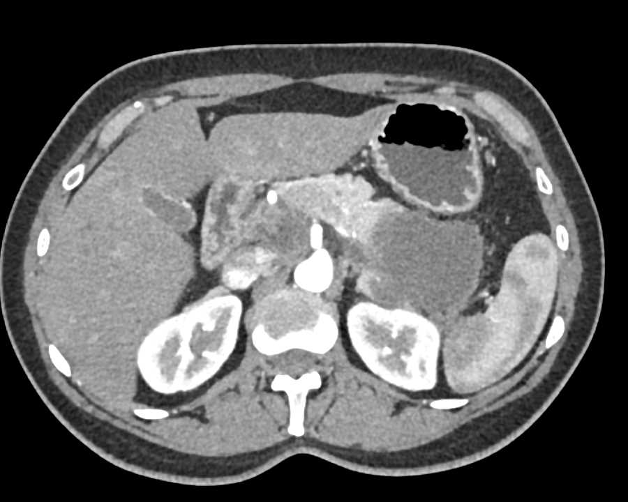 Necrotic Carcinoma Tail of Pancreas with Liver Metastases - CTisus CT Scan