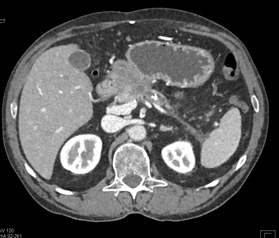 Pancreatic Cancer Invades the Portal Vein/ SMV Confluence with Cavernous Transformation of the Portal Vein (CTPV) - CTisus CT Scan