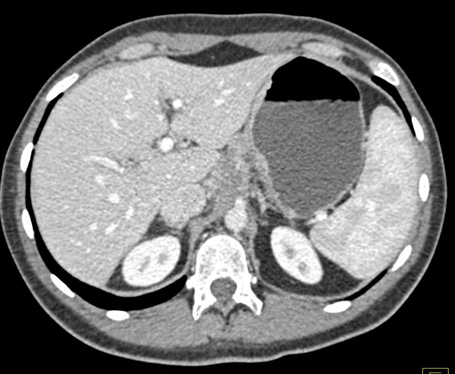 Pancreatic Cancer Encases the Celiac Axis - CTisus CT Scan