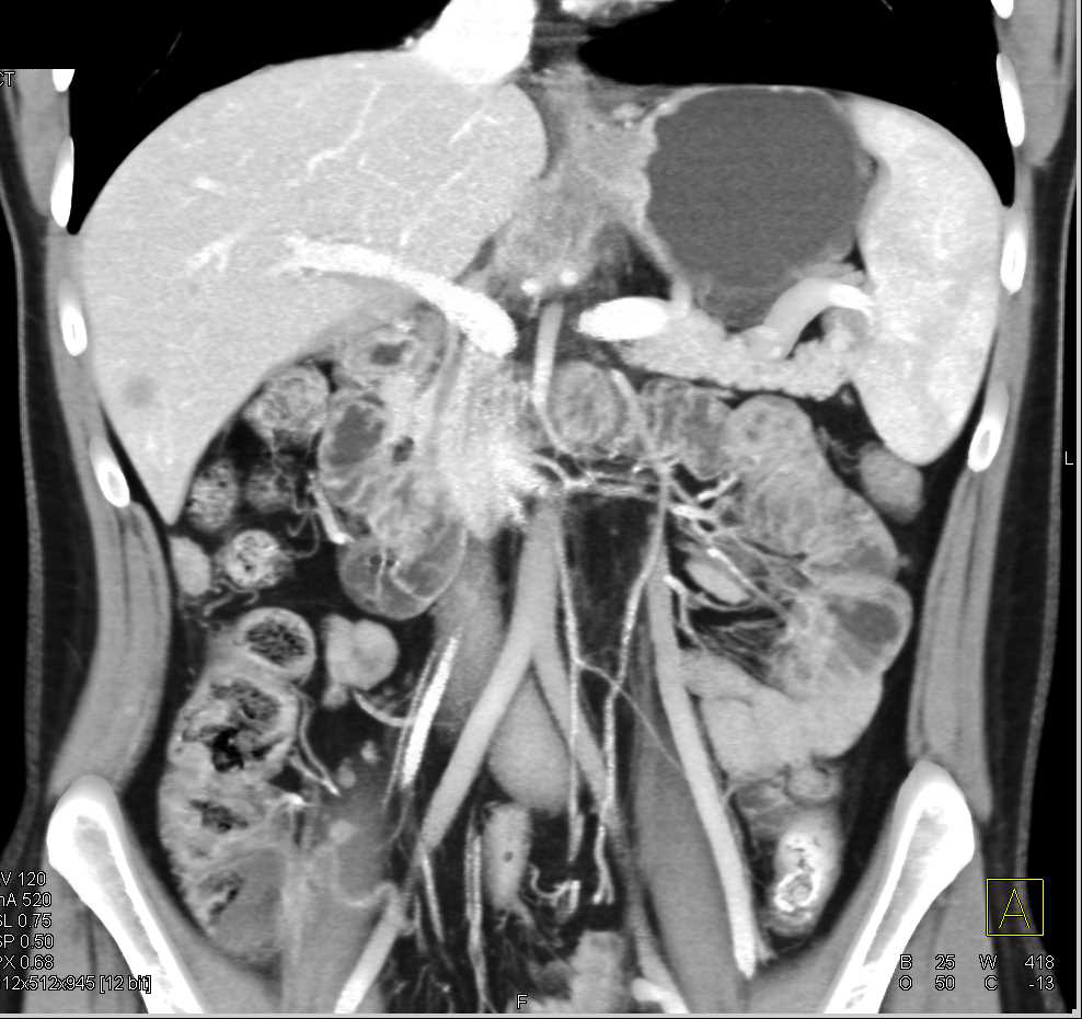 Pancreatic Cancer Encases the Celiac Axis and PV/SMV with Liver Metastases - CTisus CT Scan