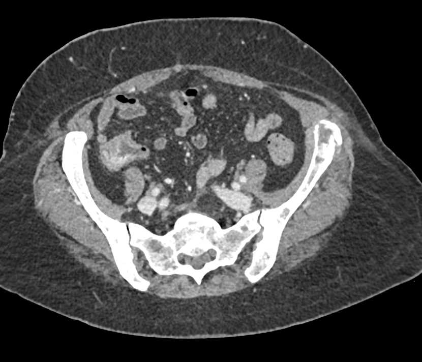 Metastatic Pancreatic Cancer to the Liver and the Left Iliac Bone - CTisus CT Scan