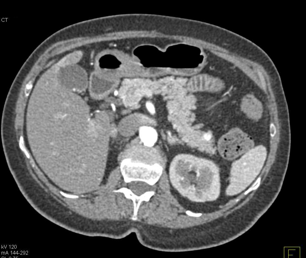 1cm Neuroendocrine Tumor in the Tail of the Pancreas - CTisus CT Scan